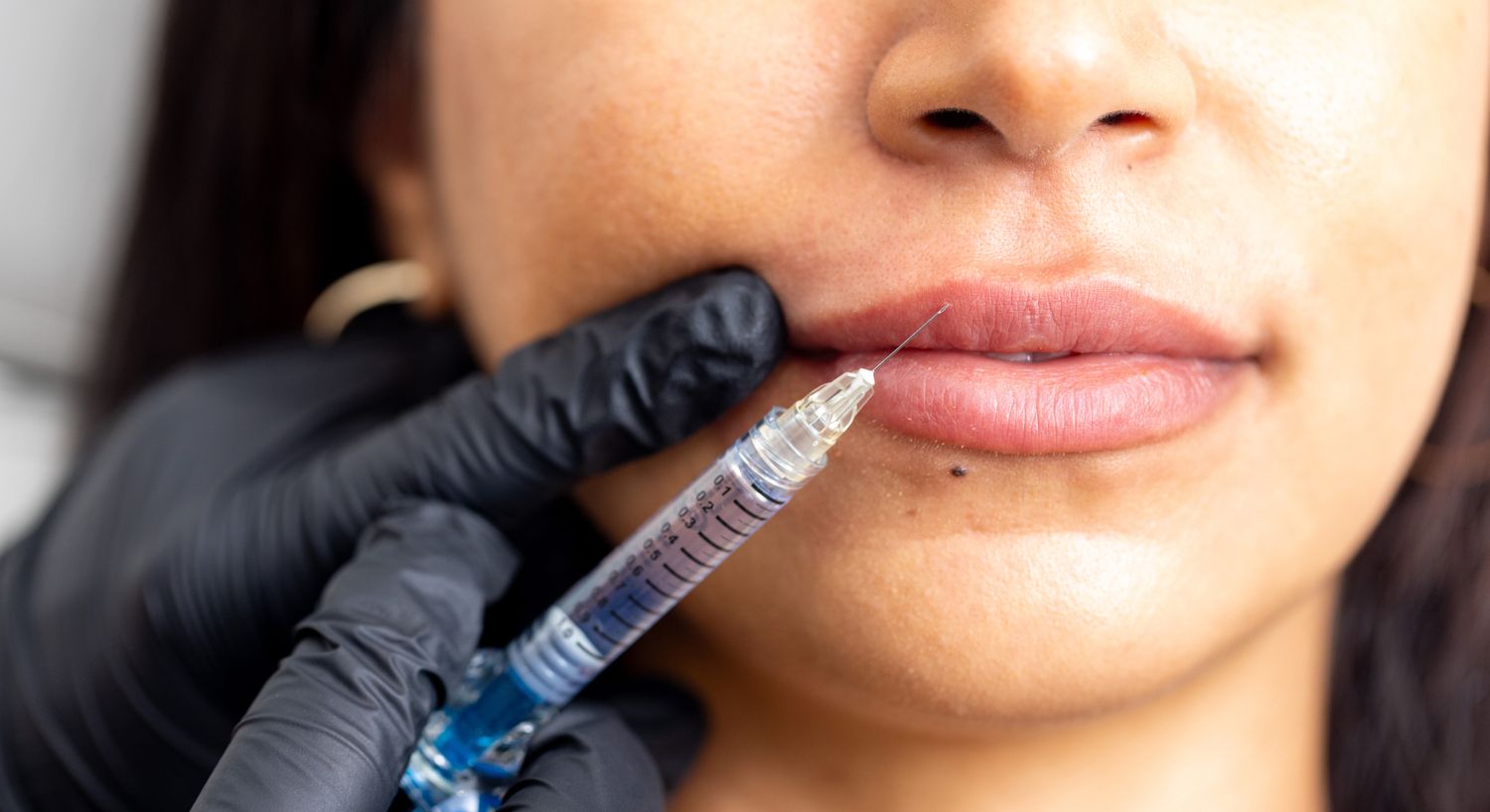 Juvederm patient model receiving an injection in her upper lip