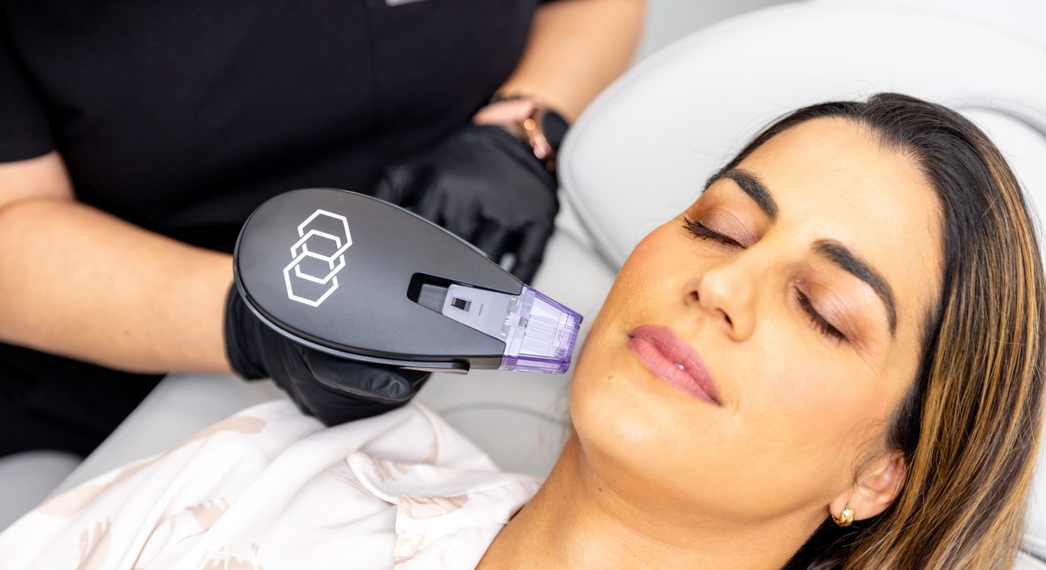 Microneedling patient model receiving treatment on her face